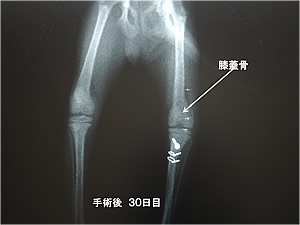 左側膝蓋骨内方脱臼症