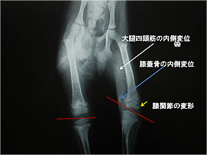 左側膝蓋骨内方脱臼症