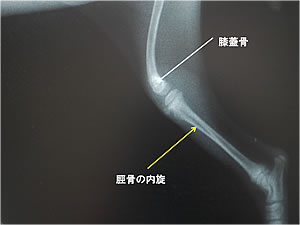 左側膝蓋骨内方脱臼症